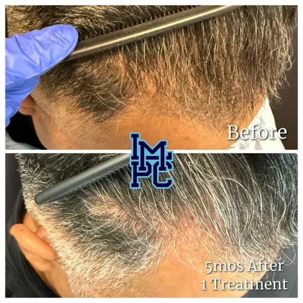Needleless Hair treatment case 6