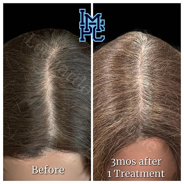 Needleless Hair treatment case 9
