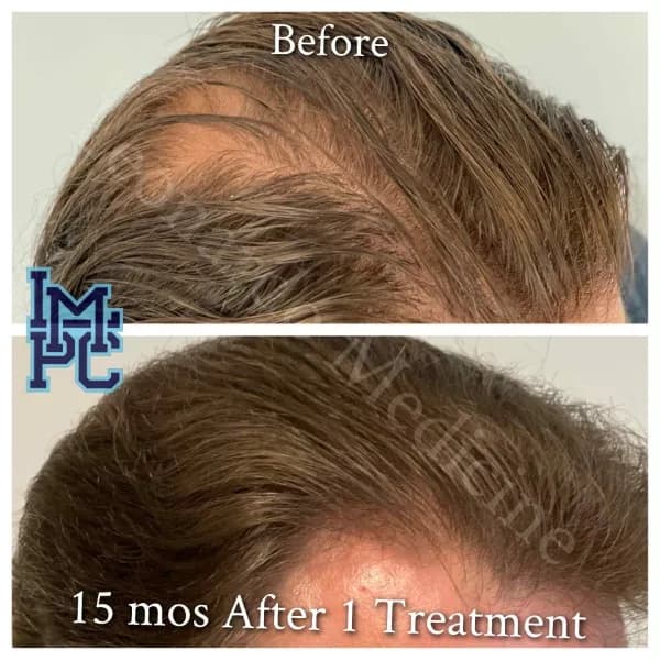 PRP Hair Treatment case 12