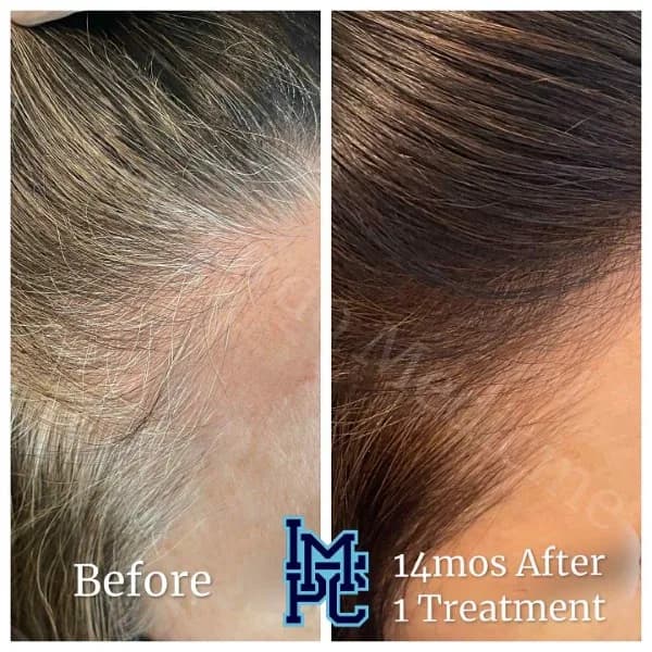 PRP Hair Treatment case 3