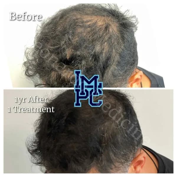 PRP Hair Treatment case 4