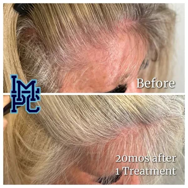 PRP Hair Treatment case 7